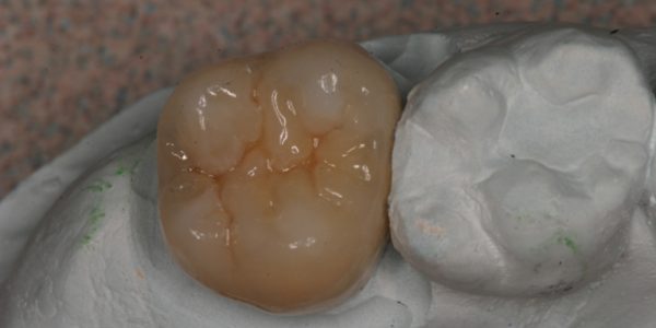 Custom Dental Shades