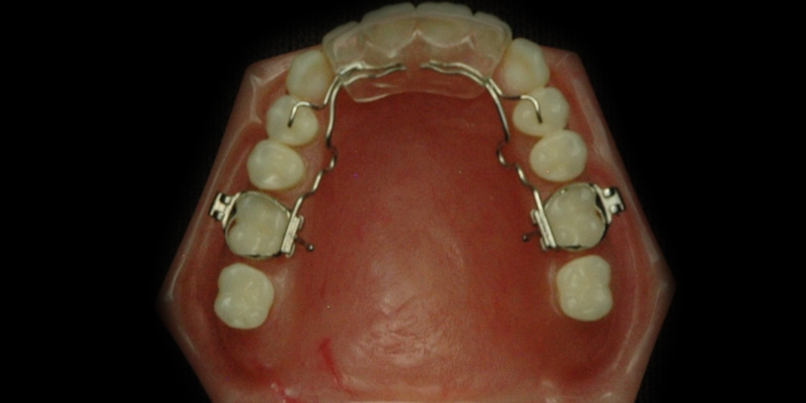 Orthodontics INTELLIGENT TOUCH DENTAL LABORATORY